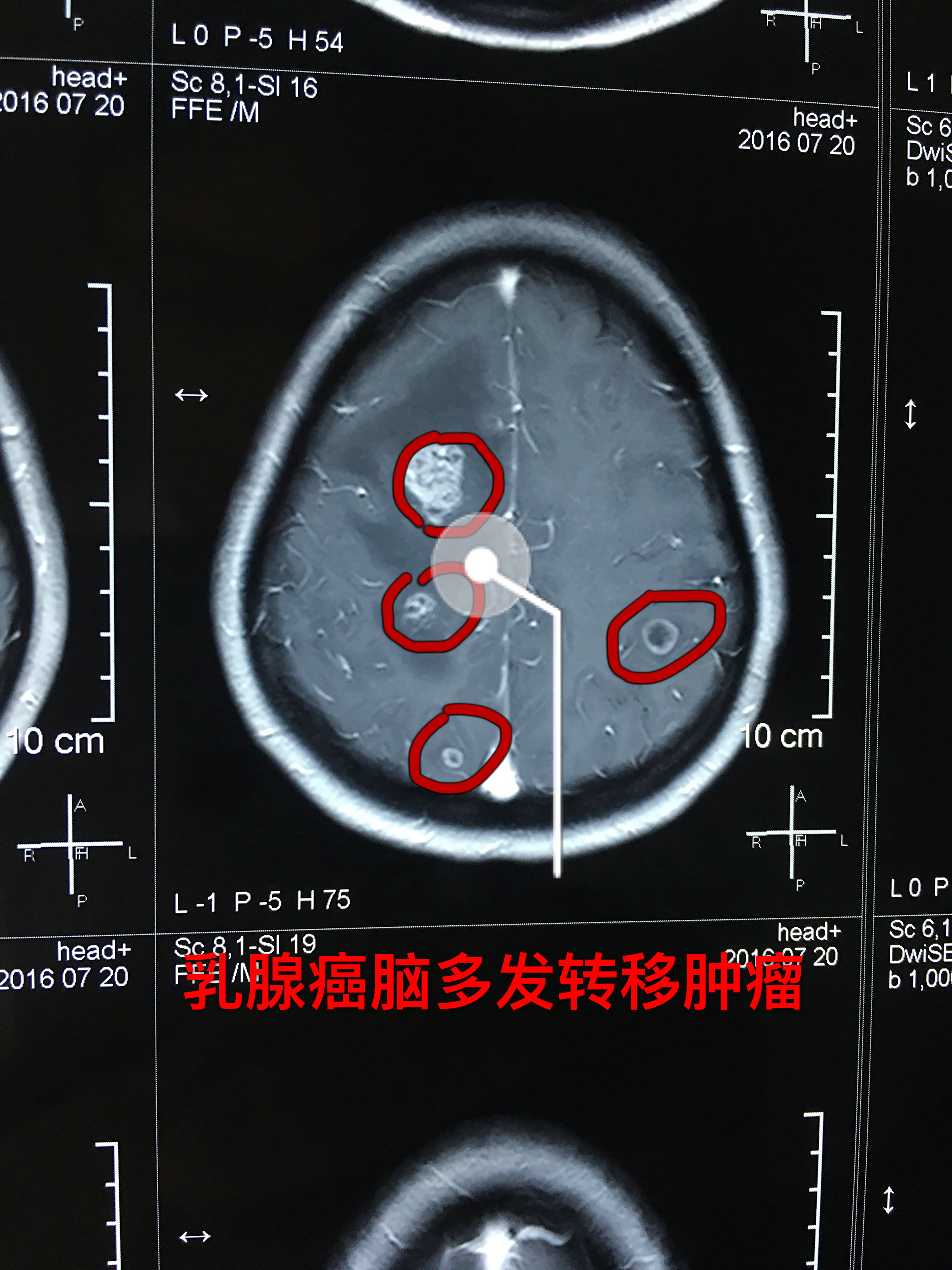 无痛绿色治疗助力乳腺癌肺脑转移