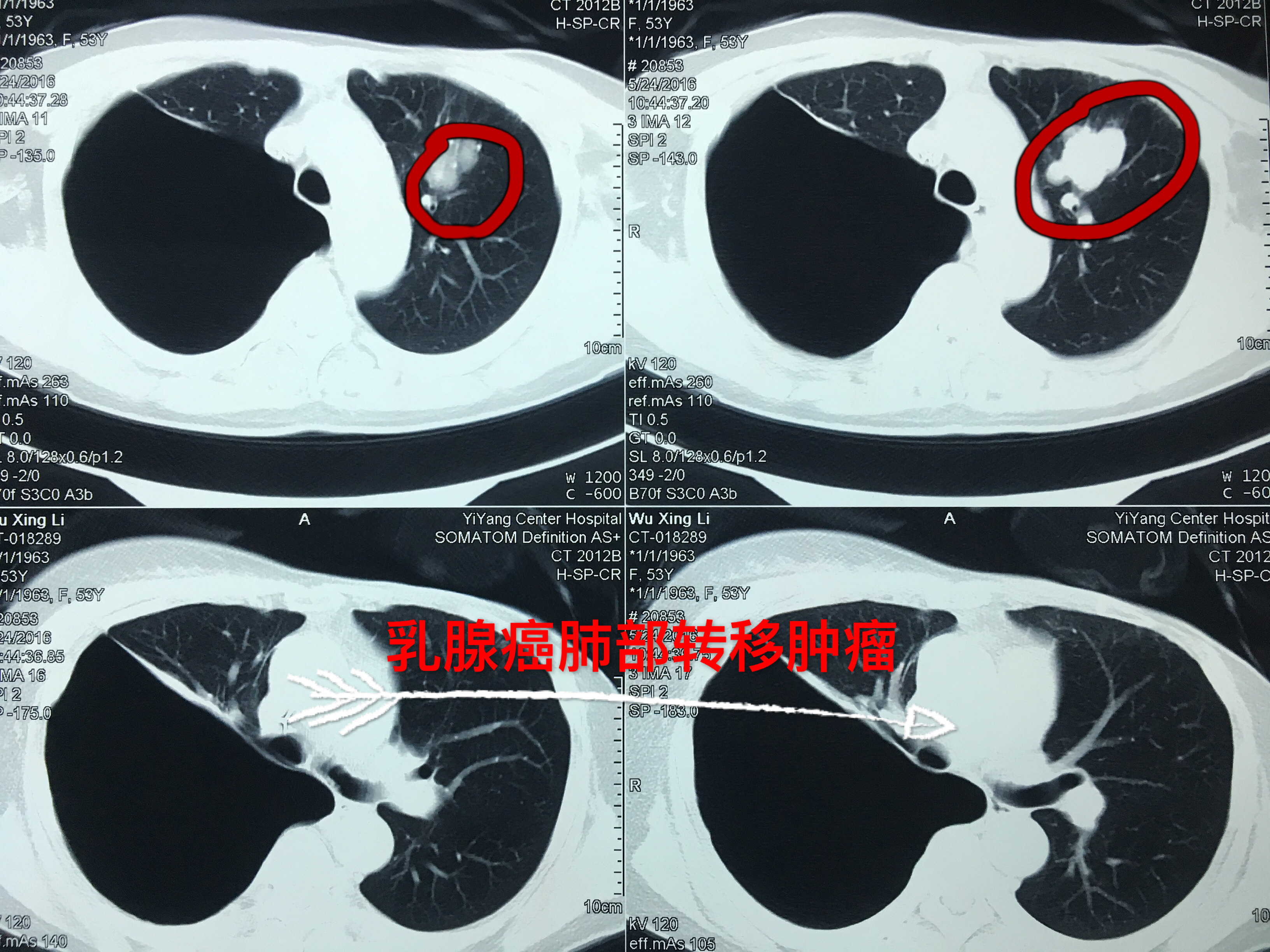 无痛绿色治疗助力乳腺癌肺脑转移