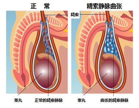 精索静脉曲张