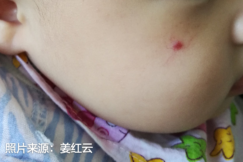 损容性皮肤病之蜘蛛痣