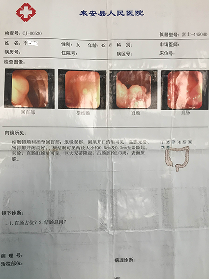 黄平 > 直肠绒毛状腺瘤癌变的腹腔镜改良isr保肛治疗 4)直肠指检:触及