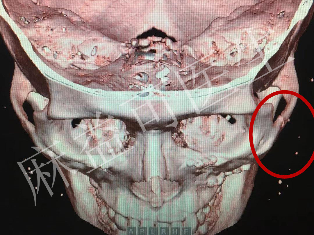 颧骨骨折类似微创手术实现完美复位和固定