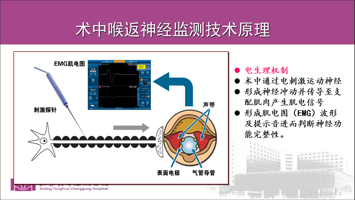 总之,术后声音嘶哑是甲状腺癌手术的并发症,其原因是术中喉返神经不