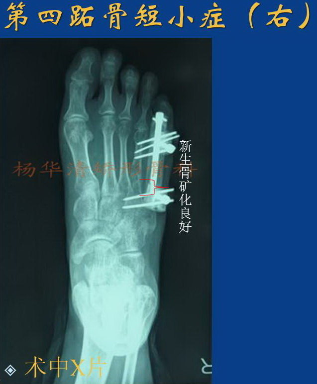 第四跖骨短小症(单足典型病例)杨华清矫形骨科