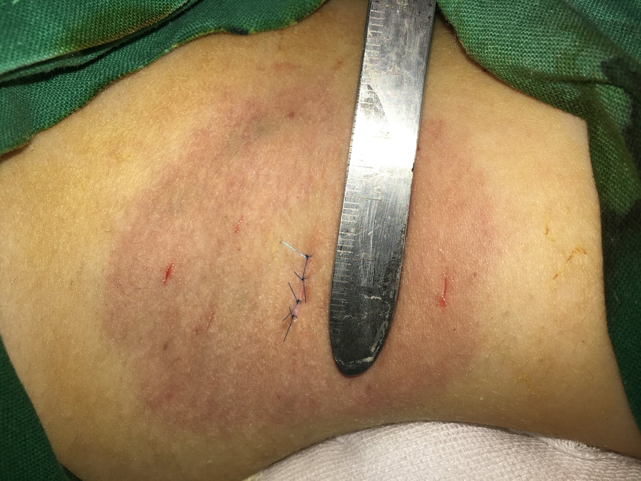 微切口腋臭根除手术,不是微创手术!