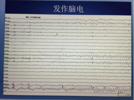 确诊颞叶癫痫需要借助辅助检查发作时脑电图最重要