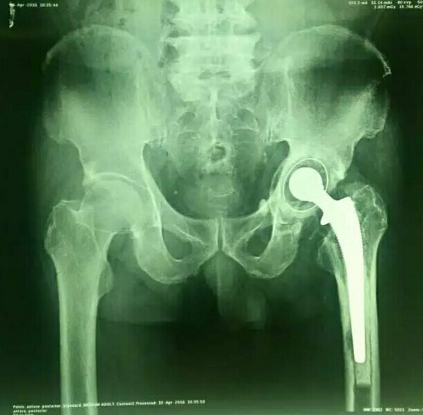 骨水泥型全髋关节置换术后10年松动,用生物型