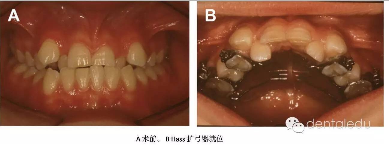 外科辅助的上颌快速扩弓same到底长什么样?