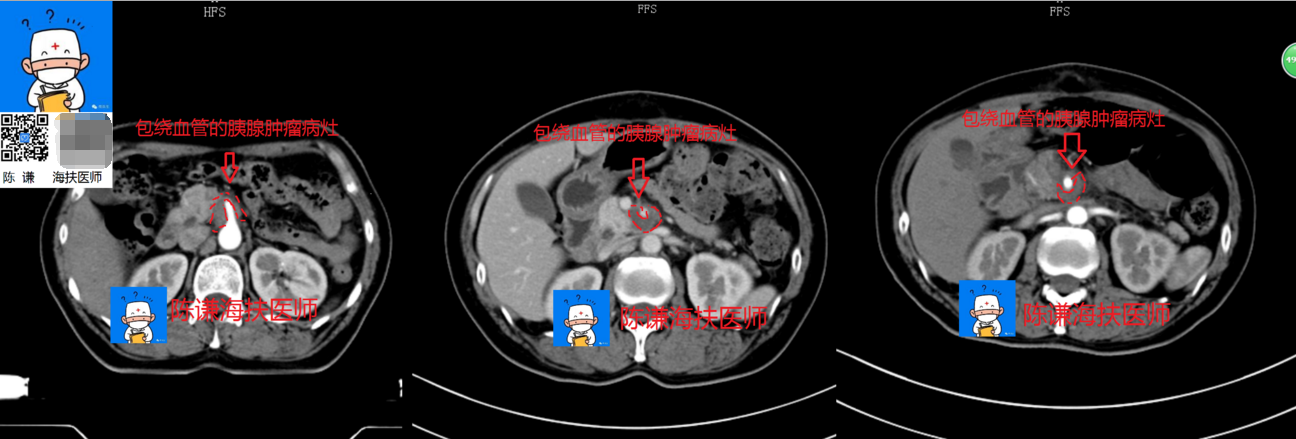 胰腺癌的海扶治疗 - 好大夫在线