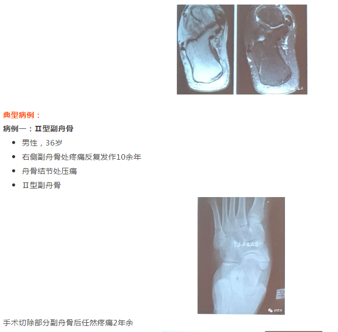 足部副舟骨需要切除吗