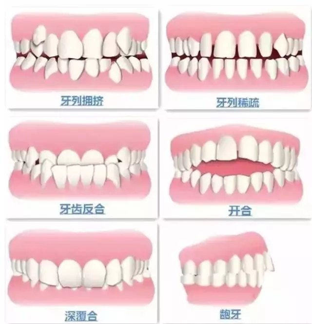 牙齿矫正前,中,后期需要注意的问题_牙颌畸形 好大夫在线