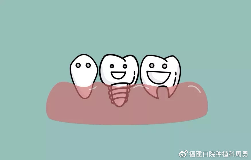 如果连续缺失了两个牙,也是需要两颗种植体来完成缺失牙的修复.
