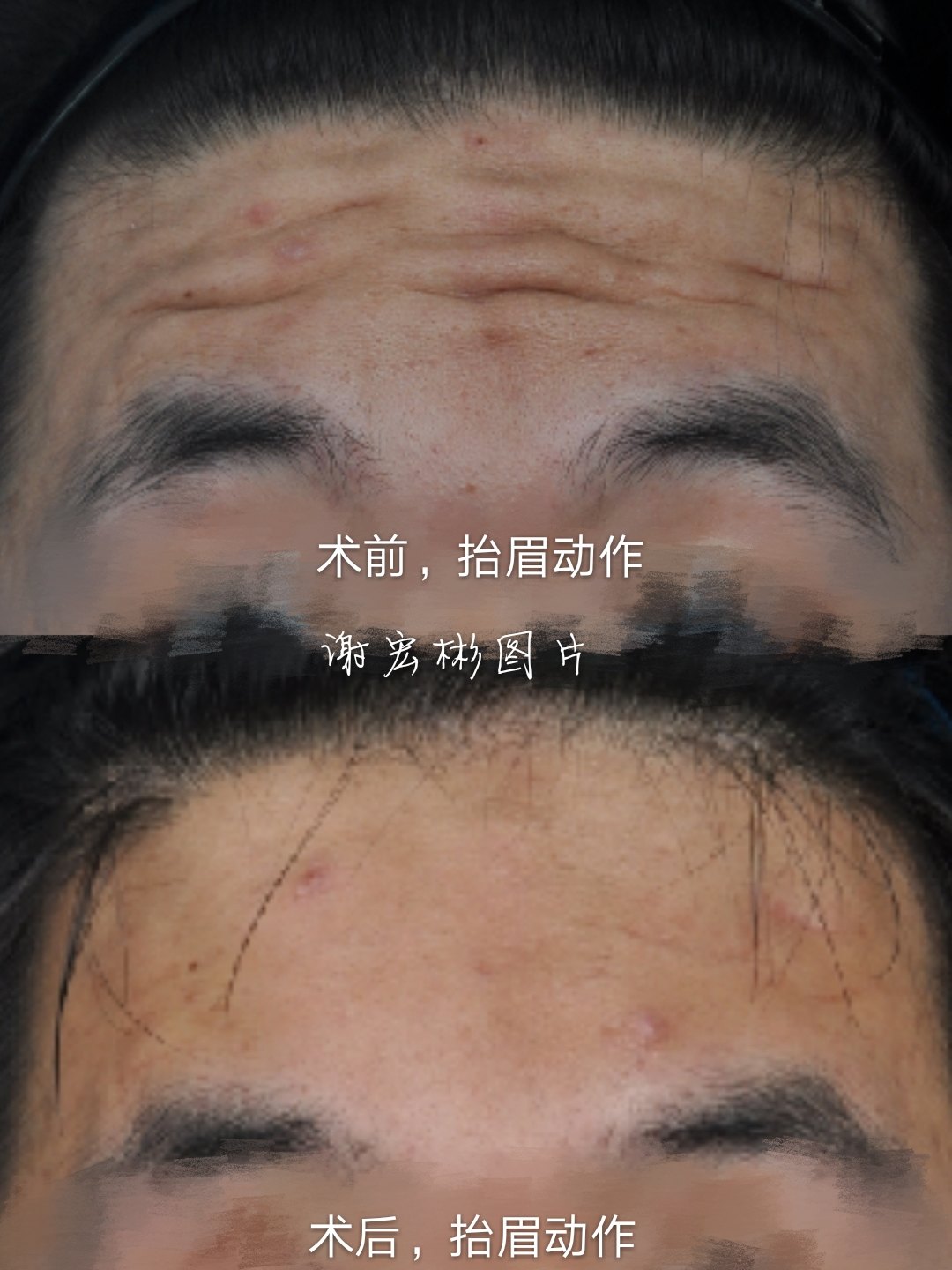 男,20岁,内窥镜去额纹和眉间纹