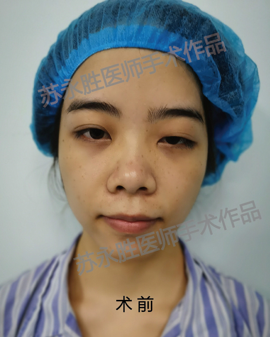 中度上睑下垂矫正病例