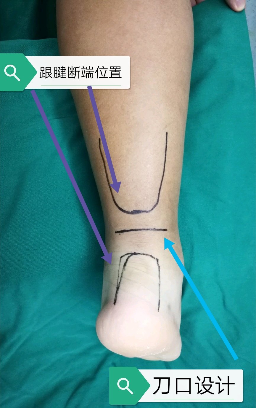 跟腱断裂微创手术