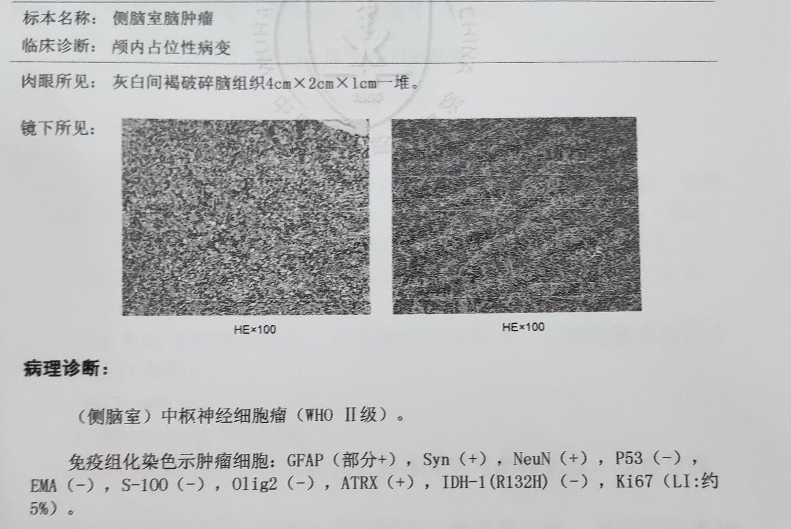 跨中线巨大脑室肿瘤中枢神经细胞瘤一种极为少见的脑肿瘤