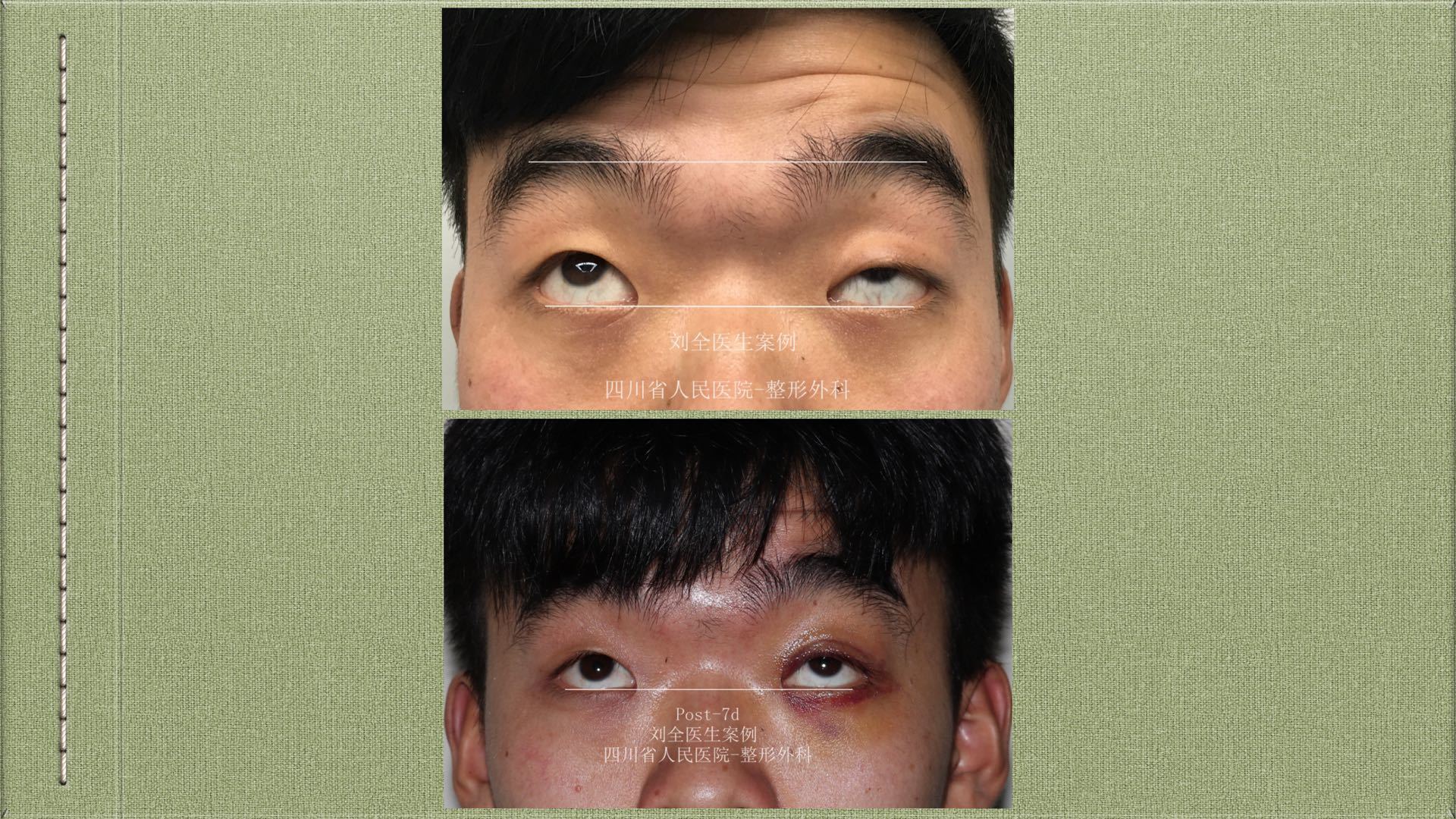 cfs~上睑下垂,用案例说话