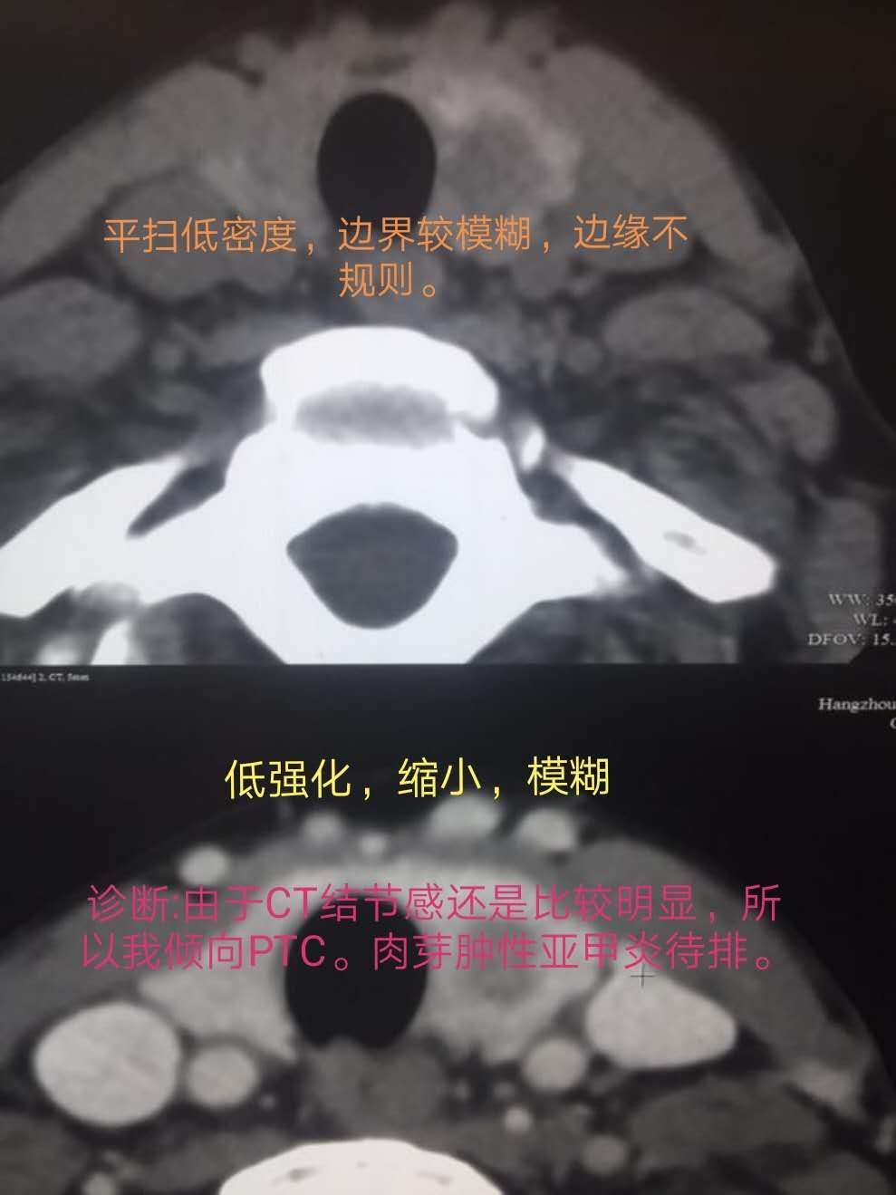 ct彩超诊断甲状腺乳头状癌易误诊亚甲炎1例