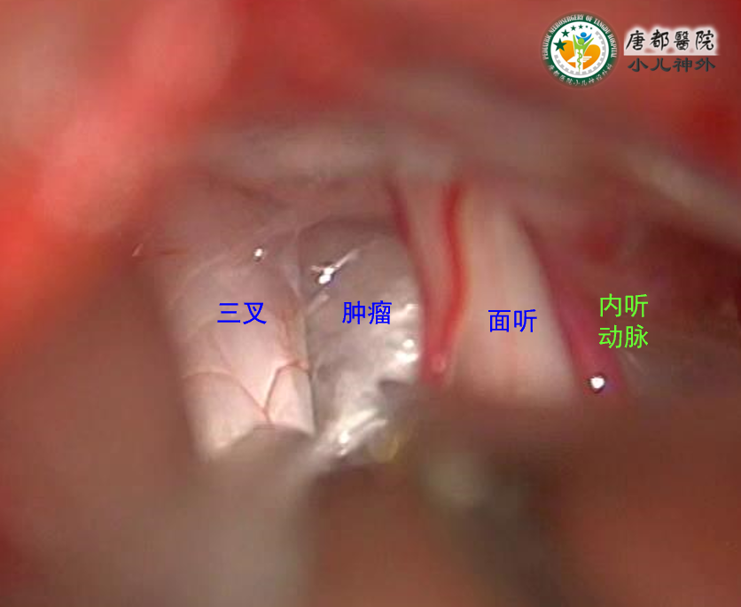 儿童后颅窝表皮样囊肿(胆脂瘤)病例分享