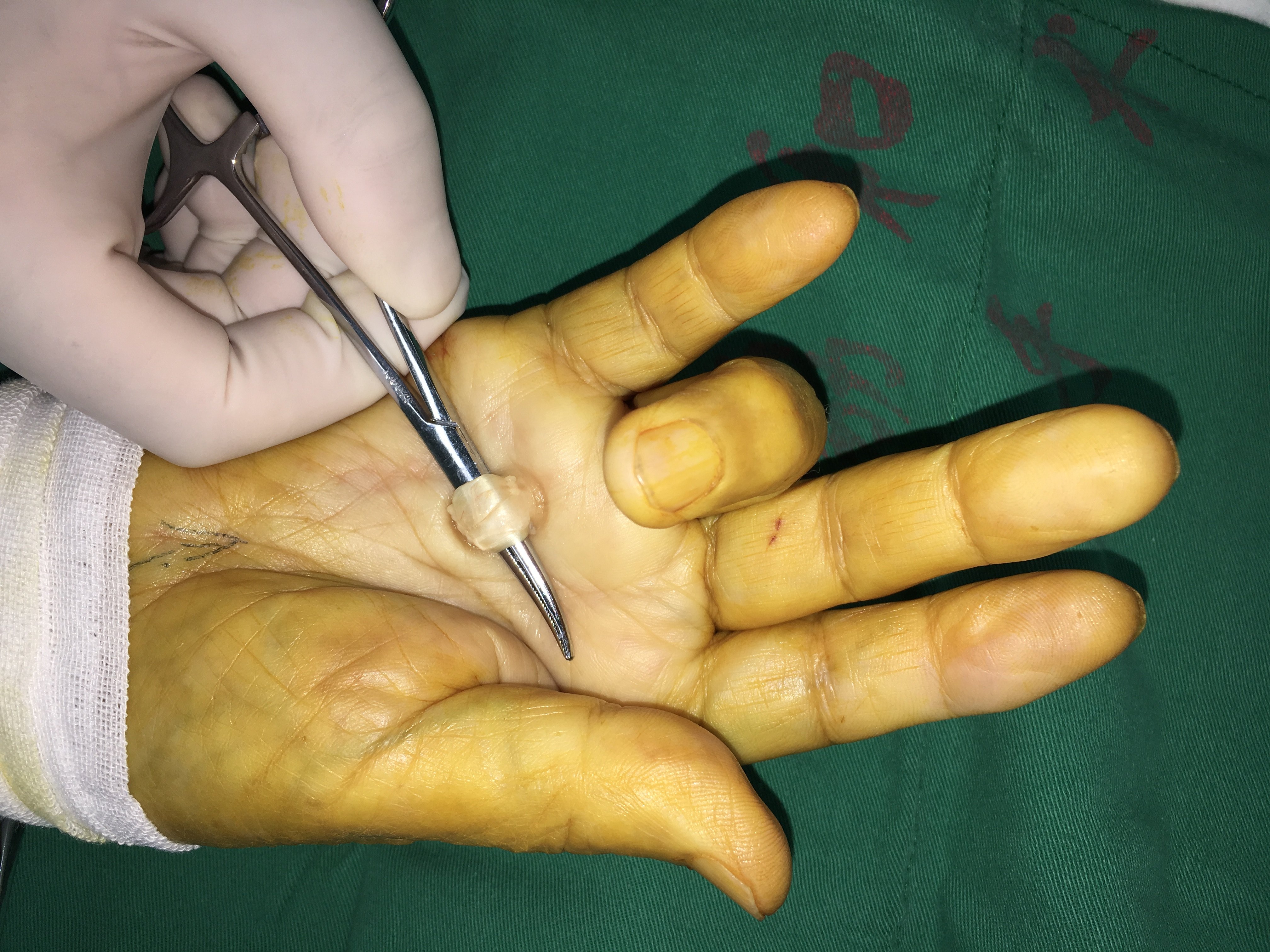 手指腱鞘炎手术