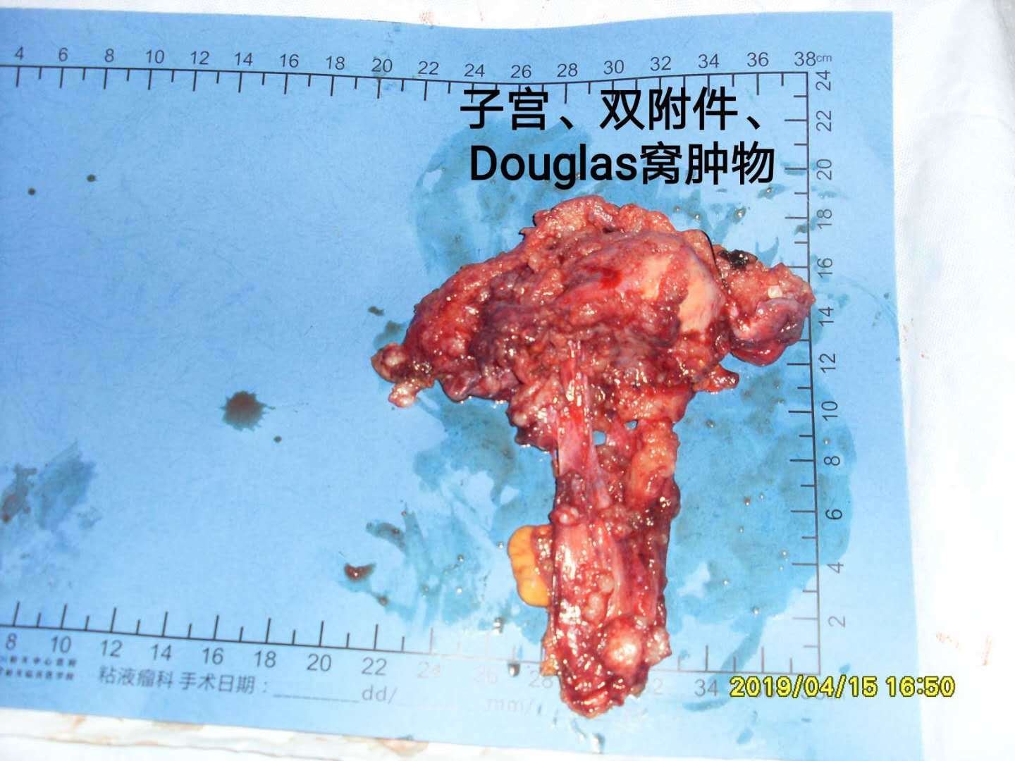 病例43pmp腹腔镜探查定为晚期肿瘤后应该怎么办