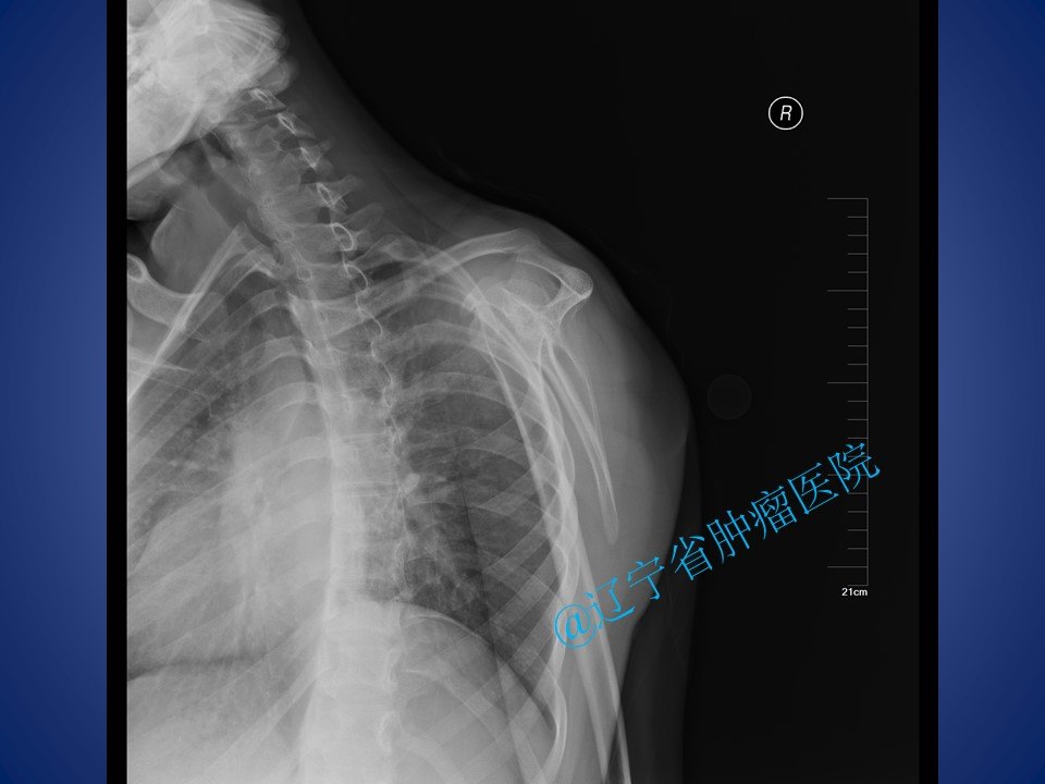 肩胛骨软骨肉瘤手术病例