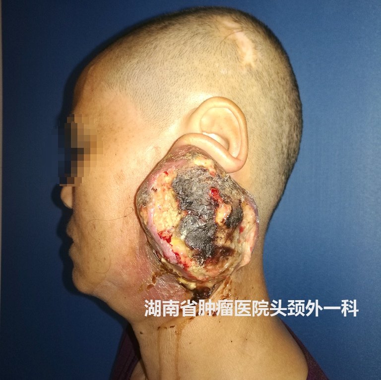 腮腺癌的治疗(附图片)_腮腺混合瘤_症状_检查_治疗