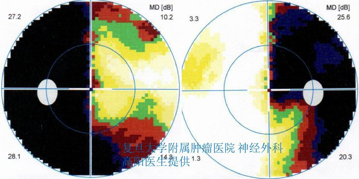 视野检查提示:双颞侧视野明显缺损(视野图黑色部分为缺损)