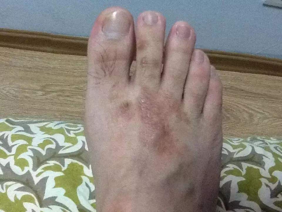 手足癣和甲癣是 皮肤癣 菌侵犯掌,跖和指(趾)所引起的浅部真菌感染性
