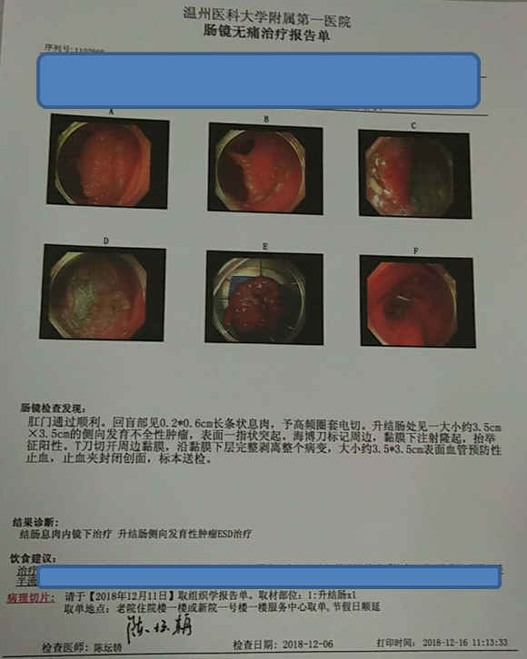 结肠侧向发育型肿瘤(lst)是什么,如何治疗?