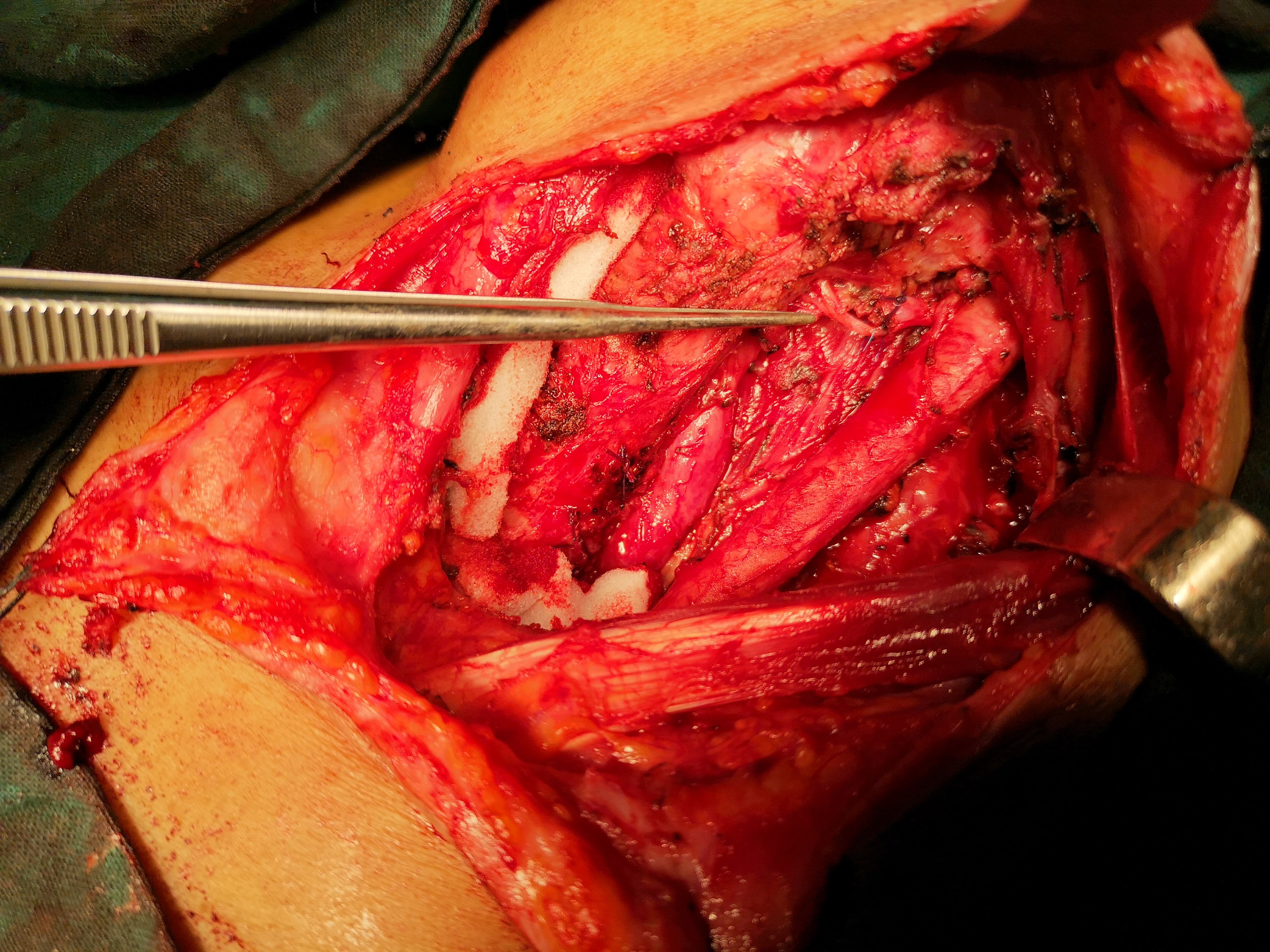 病例二手术中照片,镊子所指处,为修复首次手术损伤的喉返神经.