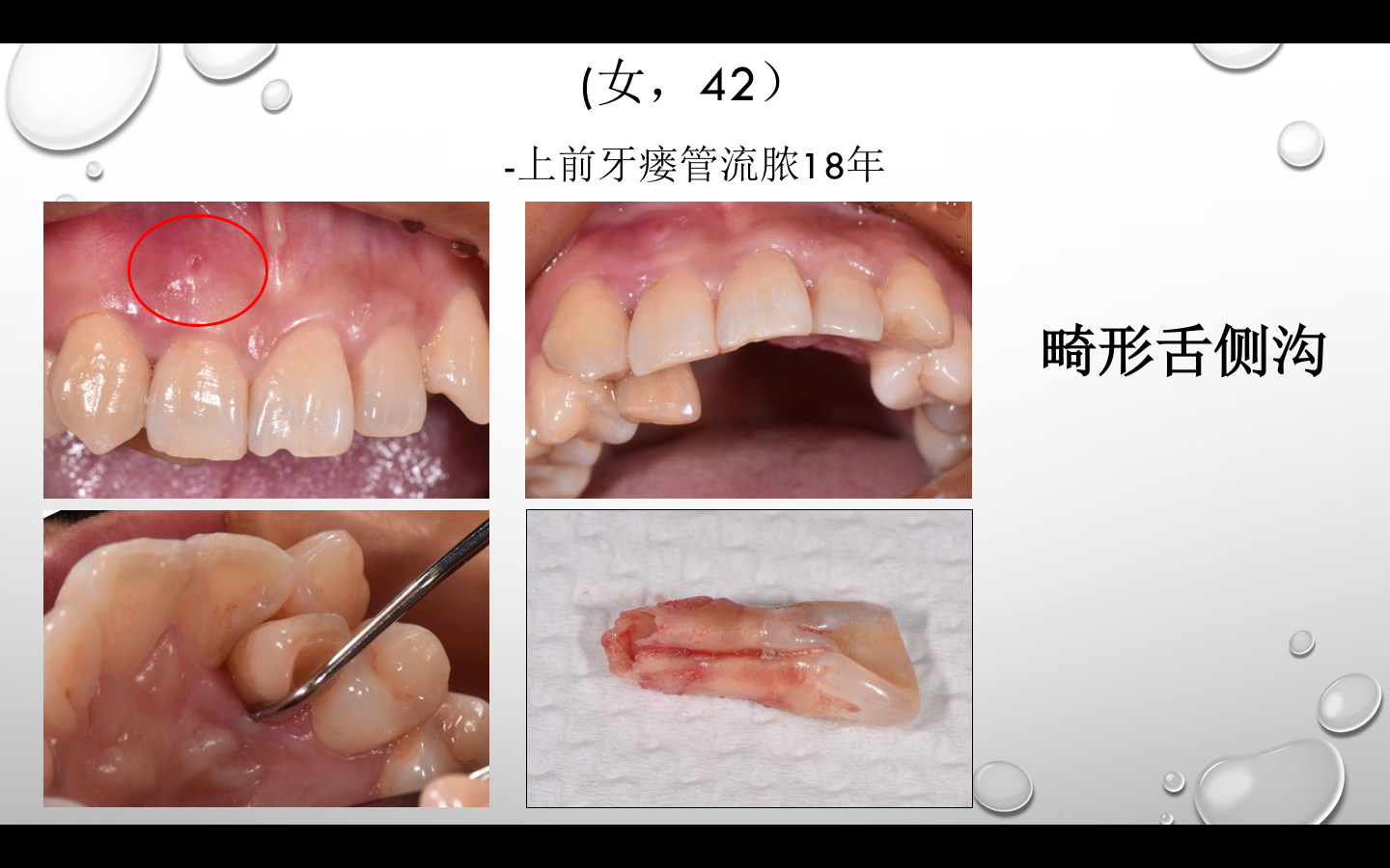这是一个牙龈流脓18年的病例,病人没有当回事,结果最后只能拔牙了