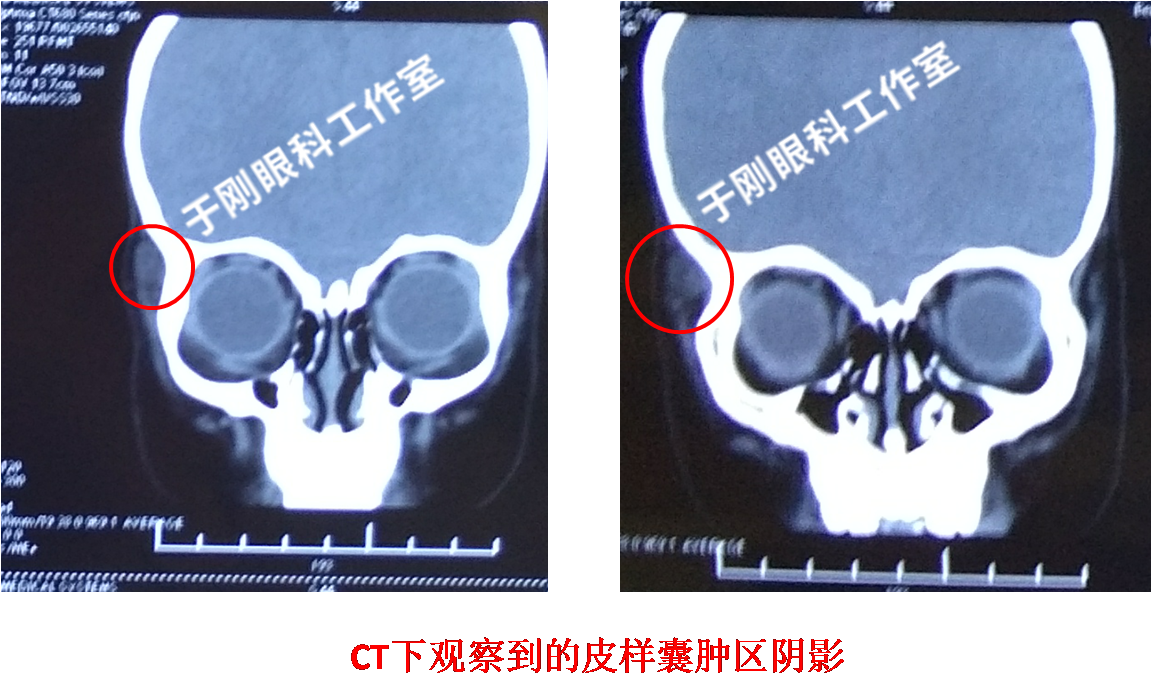 眼眶皮样囊肿—不能忽视的儿童眼睛小包包