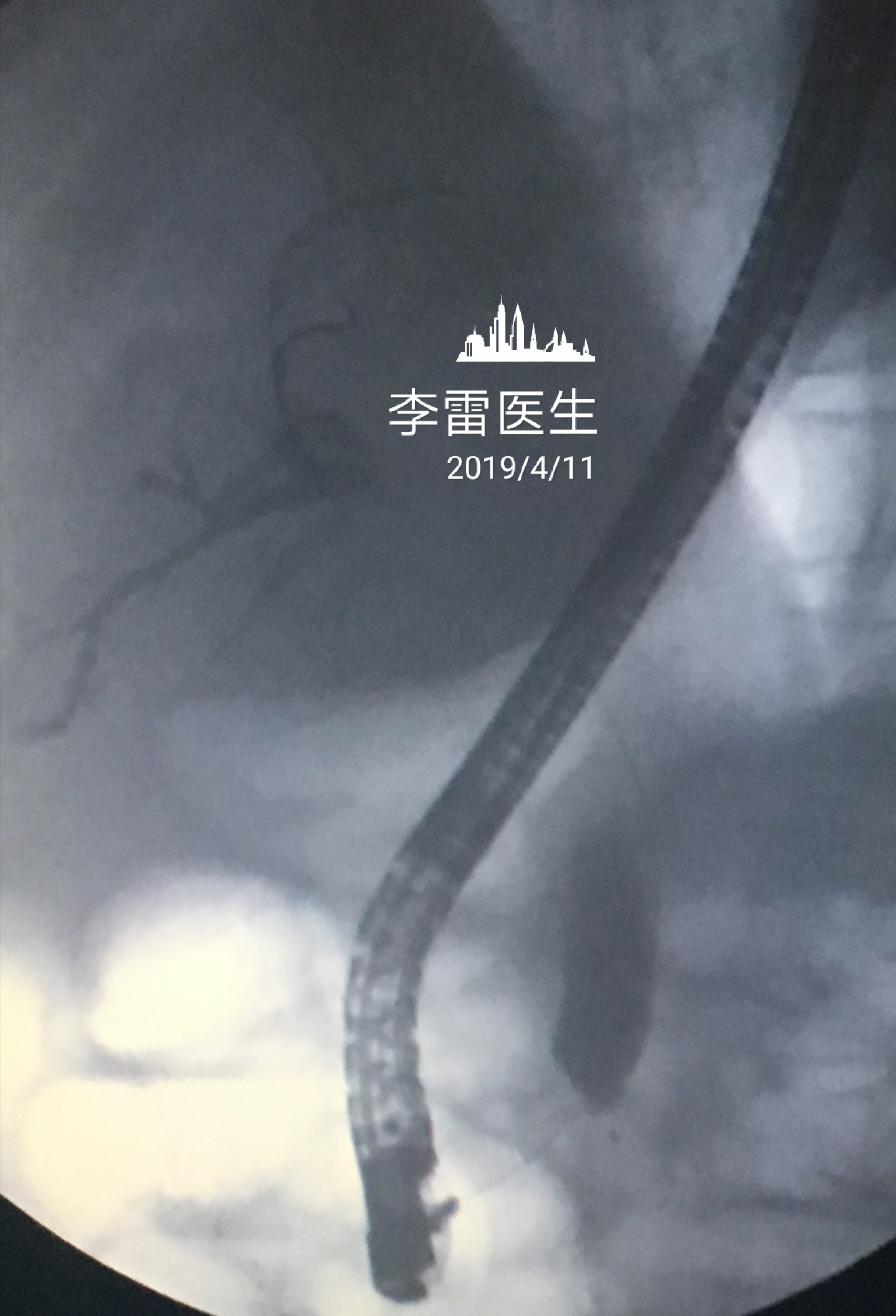 这是胆道金属支架的x线照片,显示胆道金属支架扩张良好.