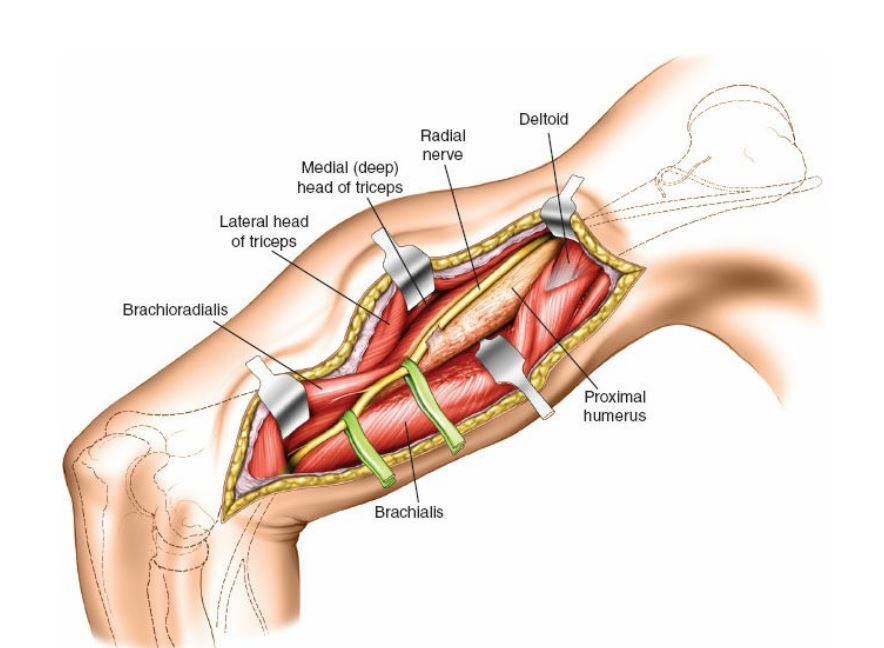 如何采用肱骨前外侧入路治疗上臂肱骨干中1/3段骨折?