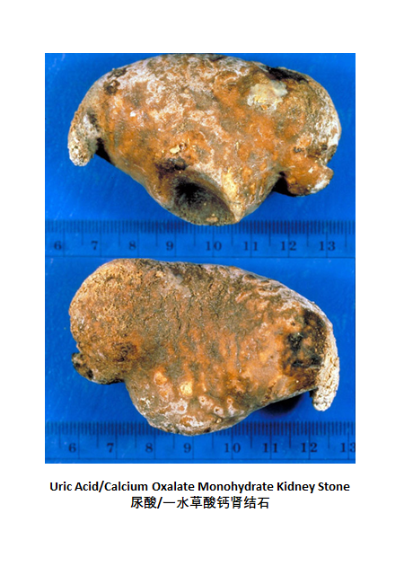 我们体内的肾结石长什么样?