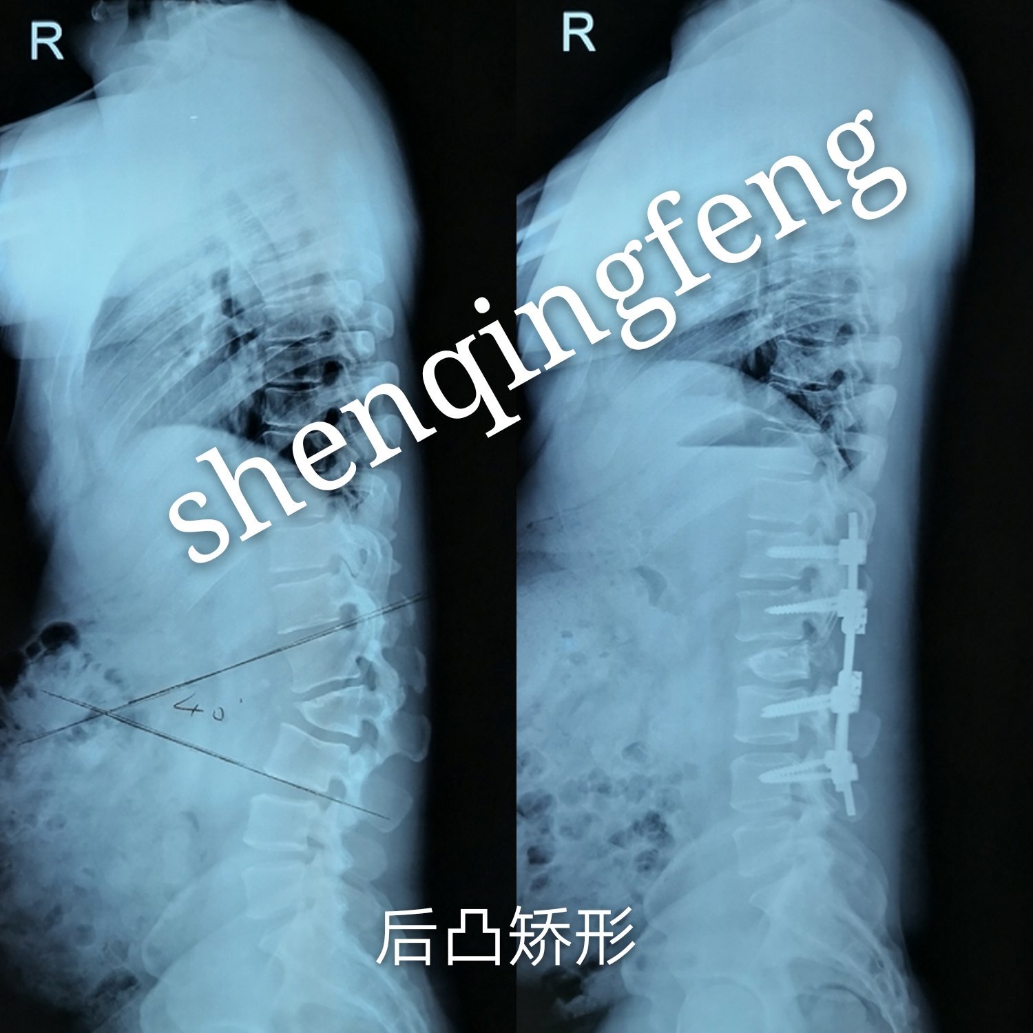 完成一例青年脊柱后凸畸形(罗锅)的矫形手术