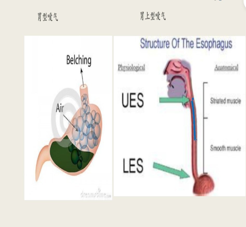 消化科常见症状嗳气打嗝篇