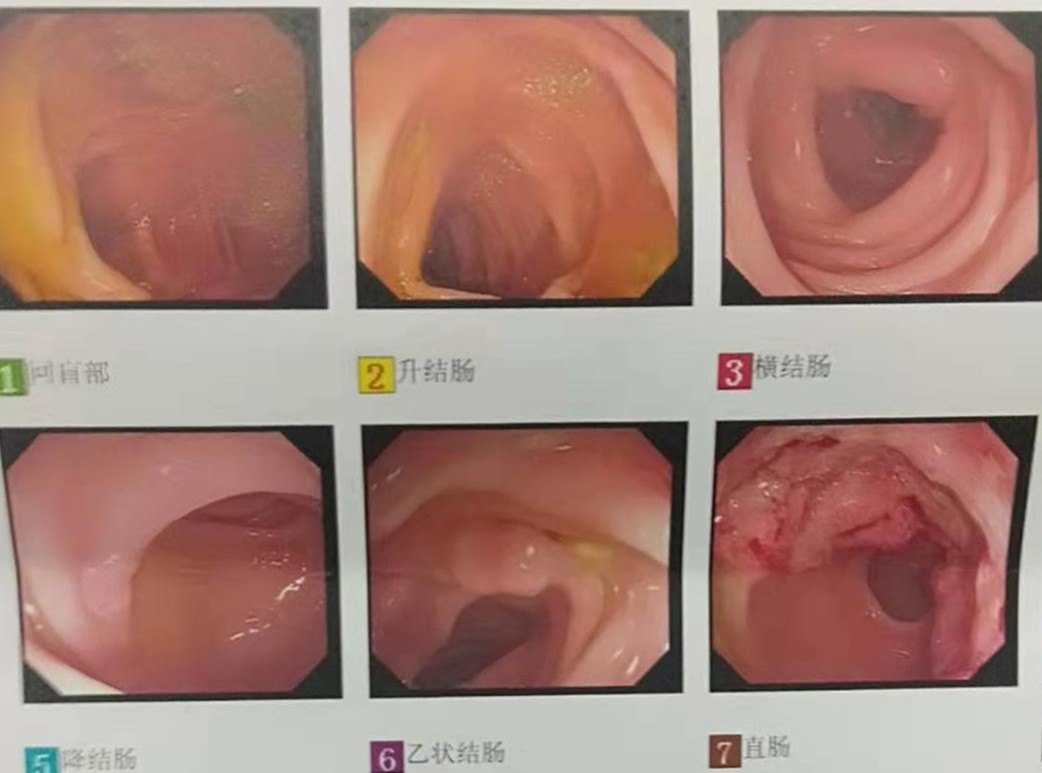 低位直肠癌能保肛吗