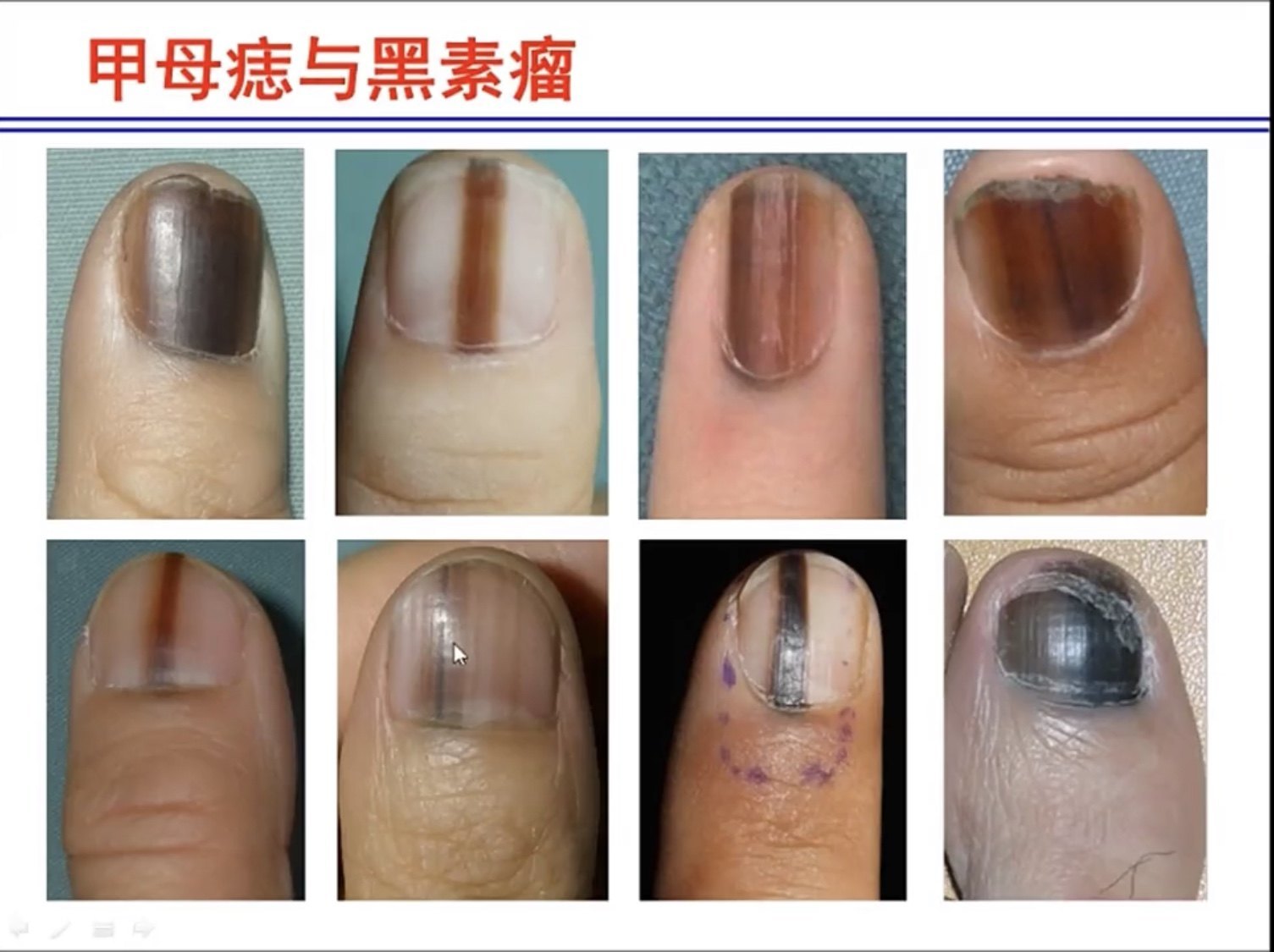 指甲纵性黑甲有可能是恶性肿瘤