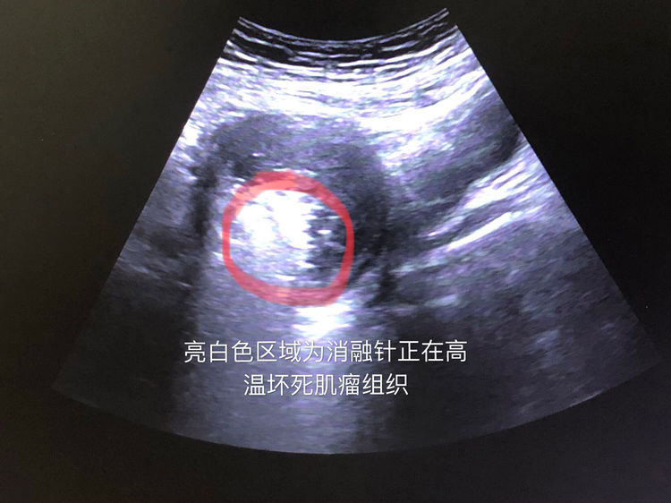 子宫肌瘤子宫腺肌瘤的精准微无创治疗方法-微波消融术