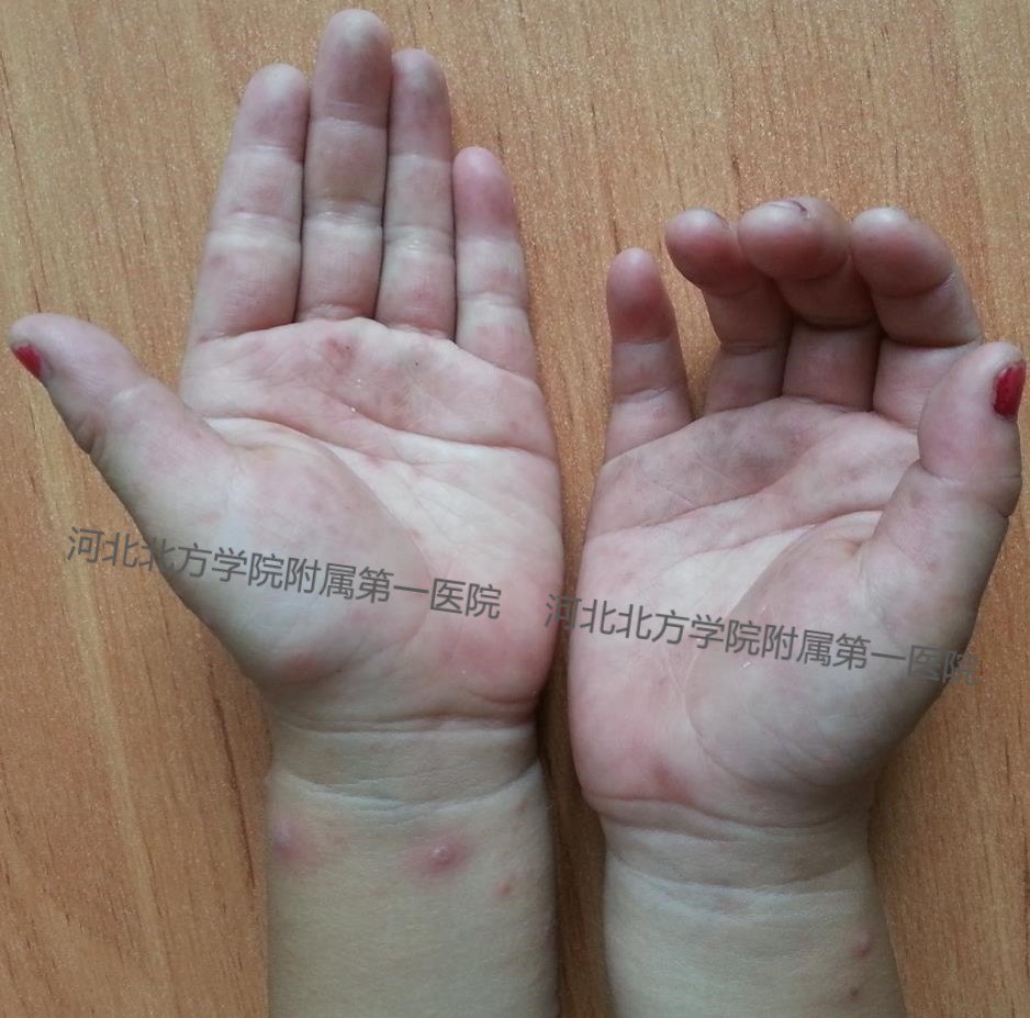 【手足口病】1,什么是手足口病?手足口病有哪些临床表现?