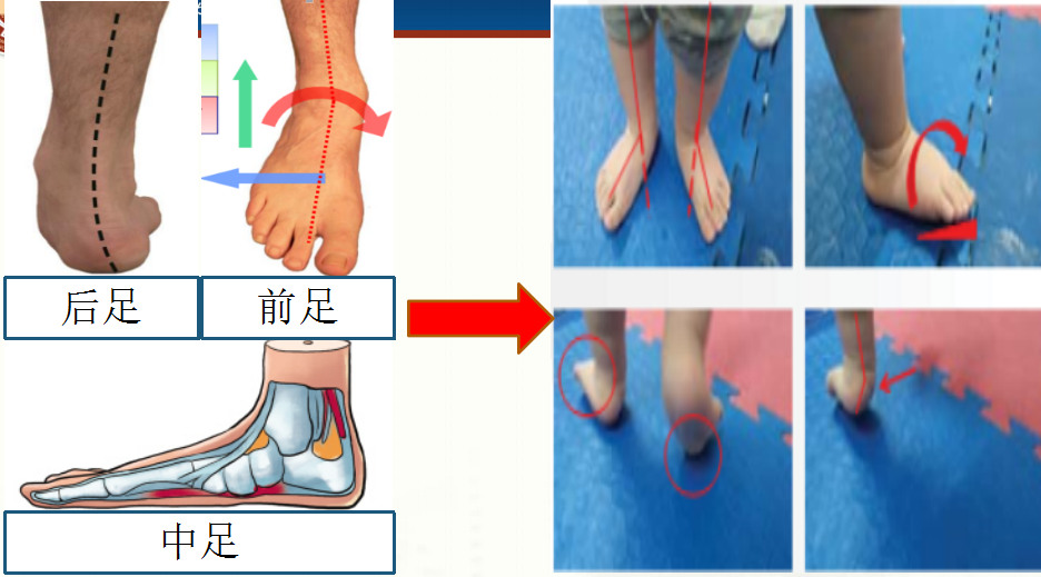 【足踝康复】--- 扁平足的康复重要性及方法