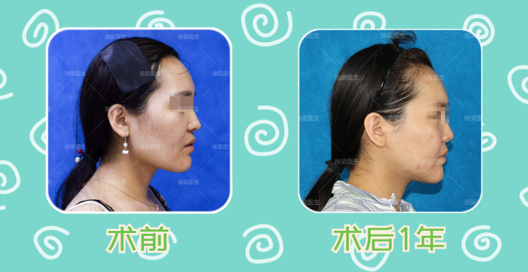 面部轮廓精品案例——颧骨 下颌骨截骨成形 术前vs术后1年