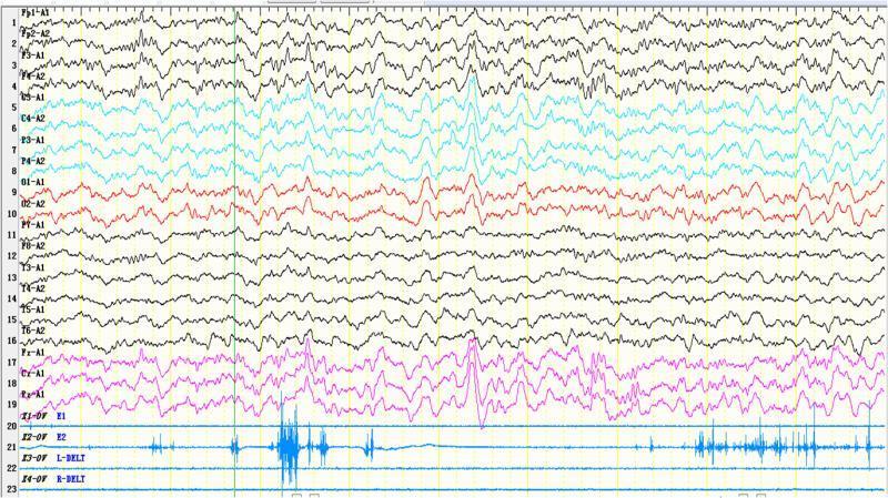 睡眠中家长指认抖动症状,同期脑电图为nrem2期,未见异常电活动.