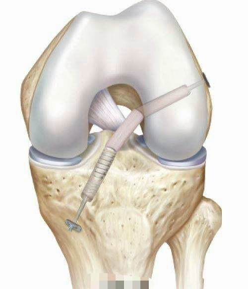 膝关节前交叉韧带重建我们的微创手术怎么做的