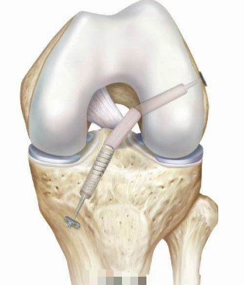 膝关节前交叉韧带重建,我们的微创手术怎么做的?