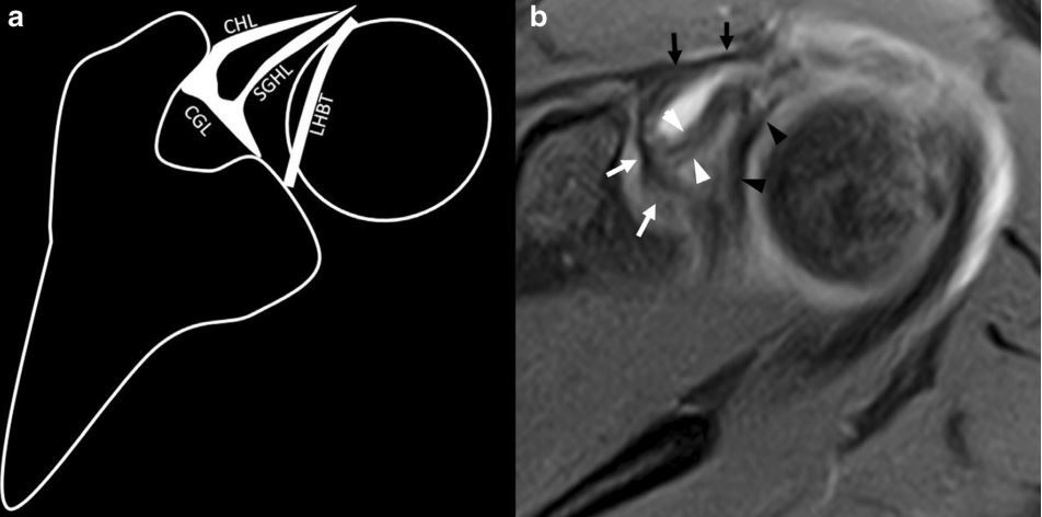 怎么在肩关节mri磁共振上看喙盂韧带喙肱韧带和上盂肱韧带