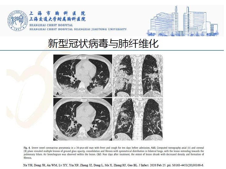 新冠病毒感染与肺纤维化
