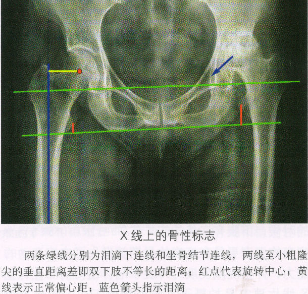 股骨头缘何会坏死?如何能早期发现?怎样预防和治疗?